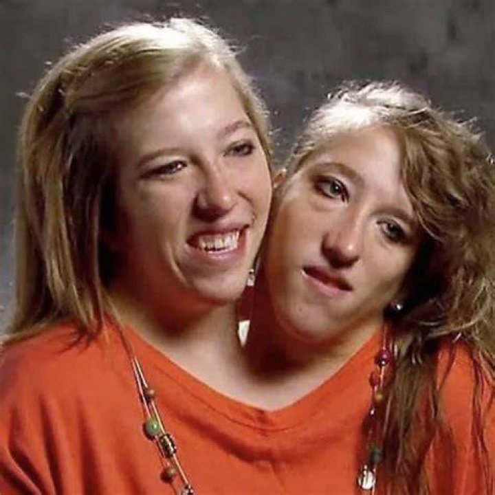 Abby and Brittany Death: The Tragic Tale of the World's Most Famous Conjoined Twins