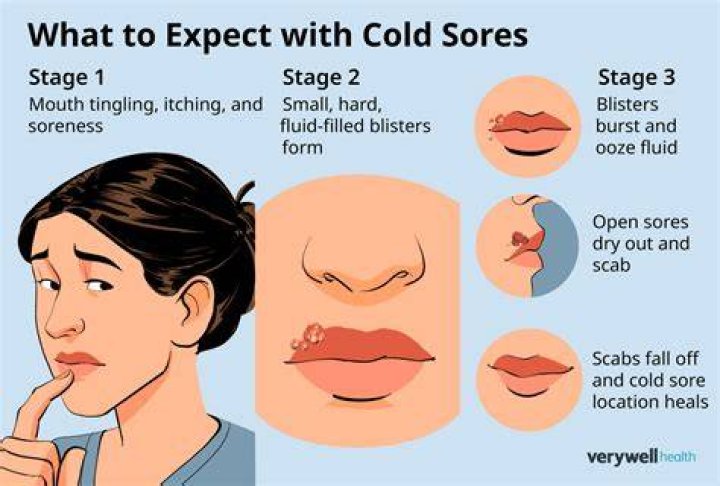 Are You Supposed to Pop Cold Sores? The Ultimate Guide to Cold Sore Management