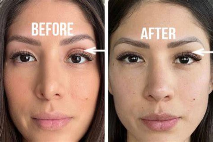 Asymmetrical Eyelids: Understanding Causes, Treatments, and Solutions