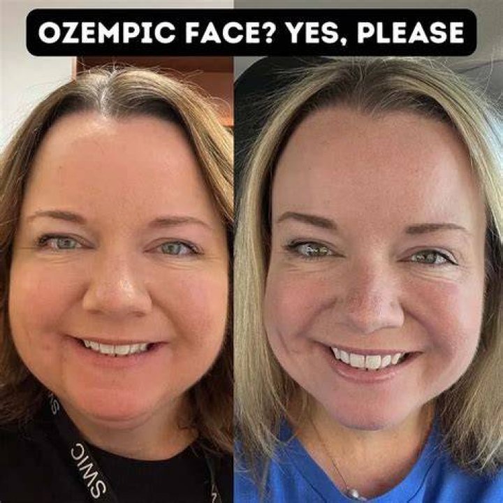 Before and After Ozempic: A Comprehensive Guide to Transforming Your Health