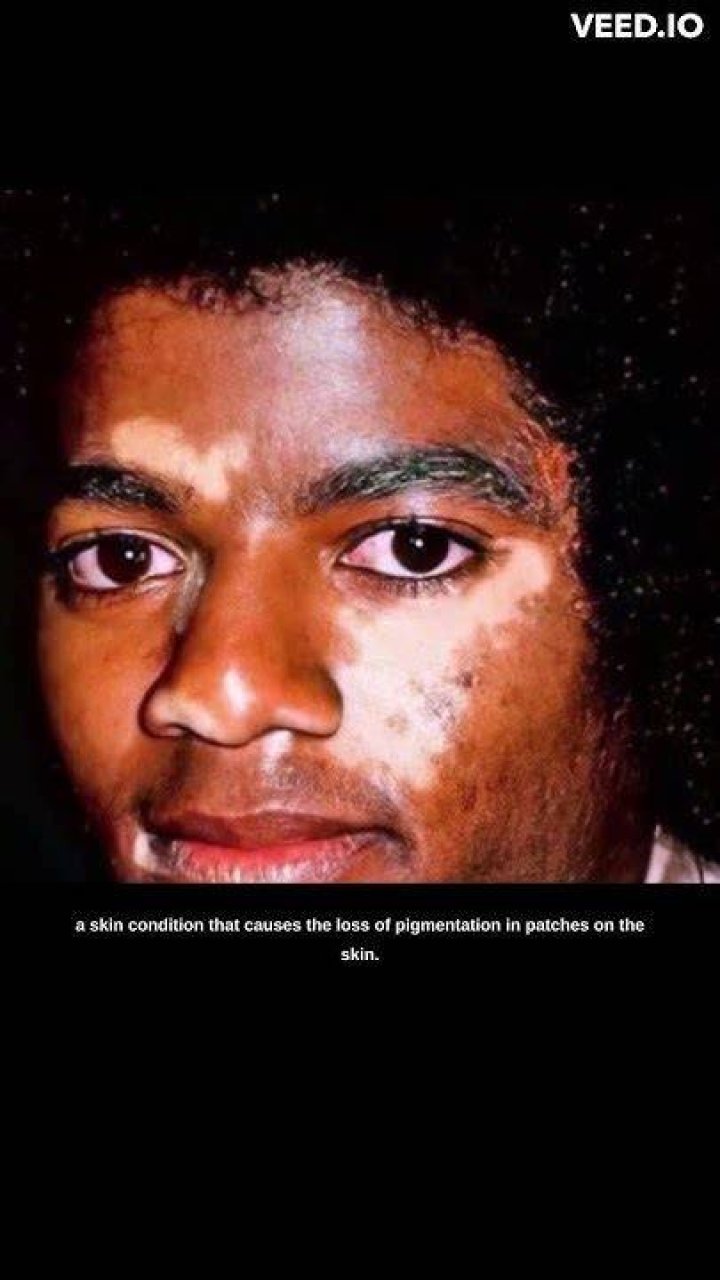 Did Michael Jackson Have Vitiligo Disease? Unveiling the Truth Behind the King of Pop's Skin Condition