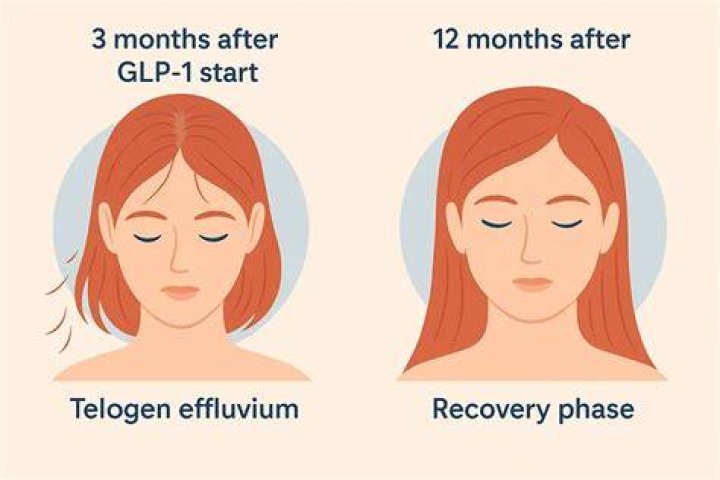 How to Stop Hair Loss with Once-Monthly GLP-1 Treatment: A Comprehensive Guide