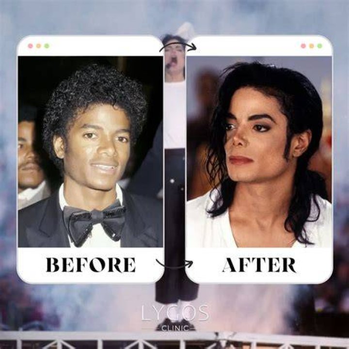 Michael Jackson's Nose Surgery: A Deep Dive into the King of Pop's Iconic Journey
