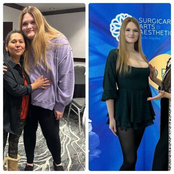 Ozempic Before and After: Transforming Lives Through Weight Loss and Diabetes Management