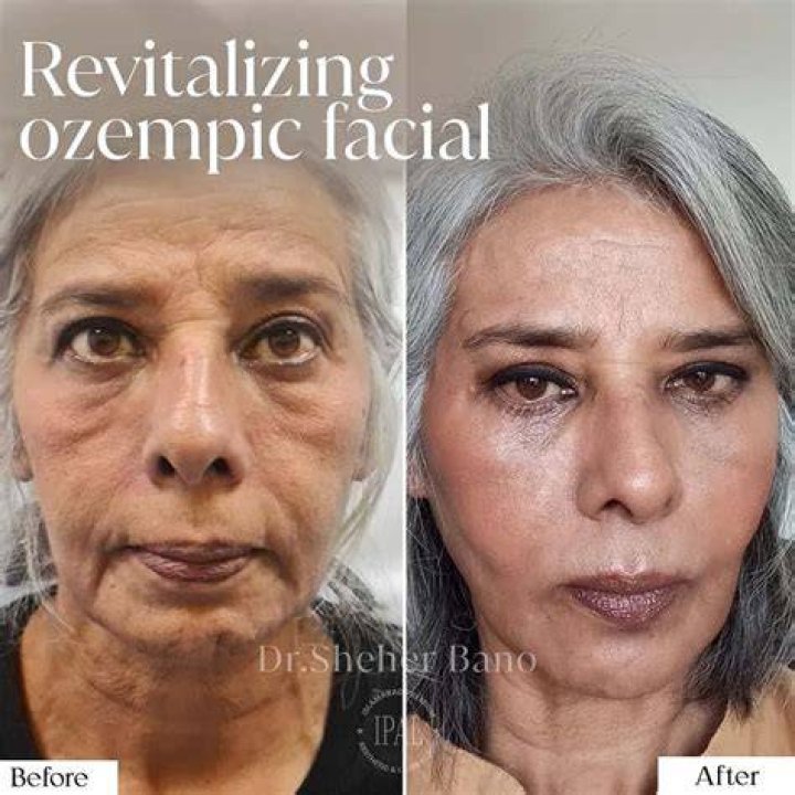 Ozempic Face Before and After: Unveiling the Transformation