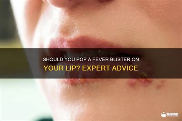 Should You Pop a Fever Blister on Lip? Comprehensive Guide and Expert Insights