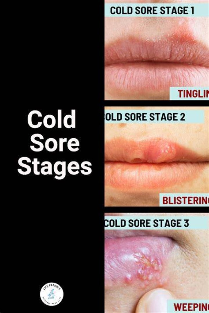 Should You Pop Cold Sores? The Ultimate Guide to Cold Sore Management