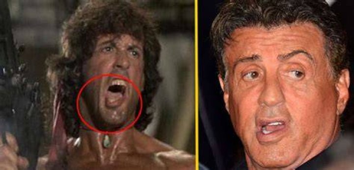 Sylvester Stallone Face Paralysis: Understanding the Actor's Journey with Facial Paralysis