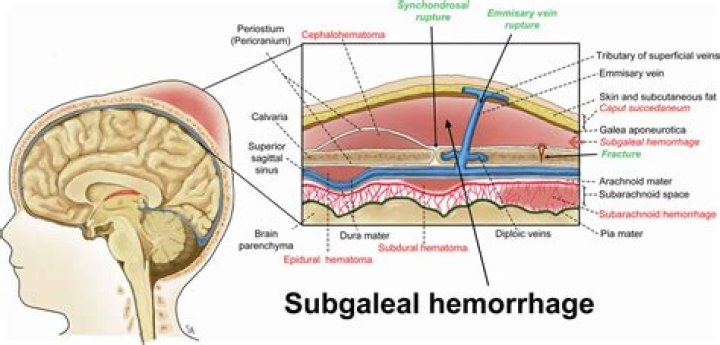 Understanding Subgaleal Bleeding: Causes, Symptoms, Diagnosis, and Treatment