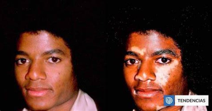When Did Michael Jackson Get Vitiligo: A Comprehensive Guide